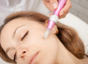 microneedling procedure