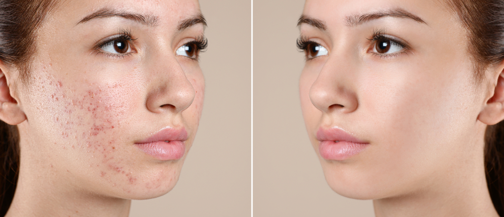 Before and after results of Morpheus8 treatment showing improved skin tightening and wrinkle reduction.