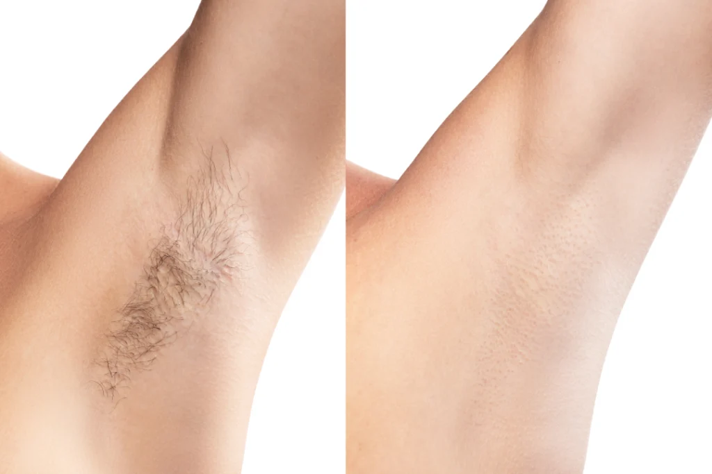 Side-by-side comparison of an armpit before and after laser hair removal treatment, showing significant reduction in hair.