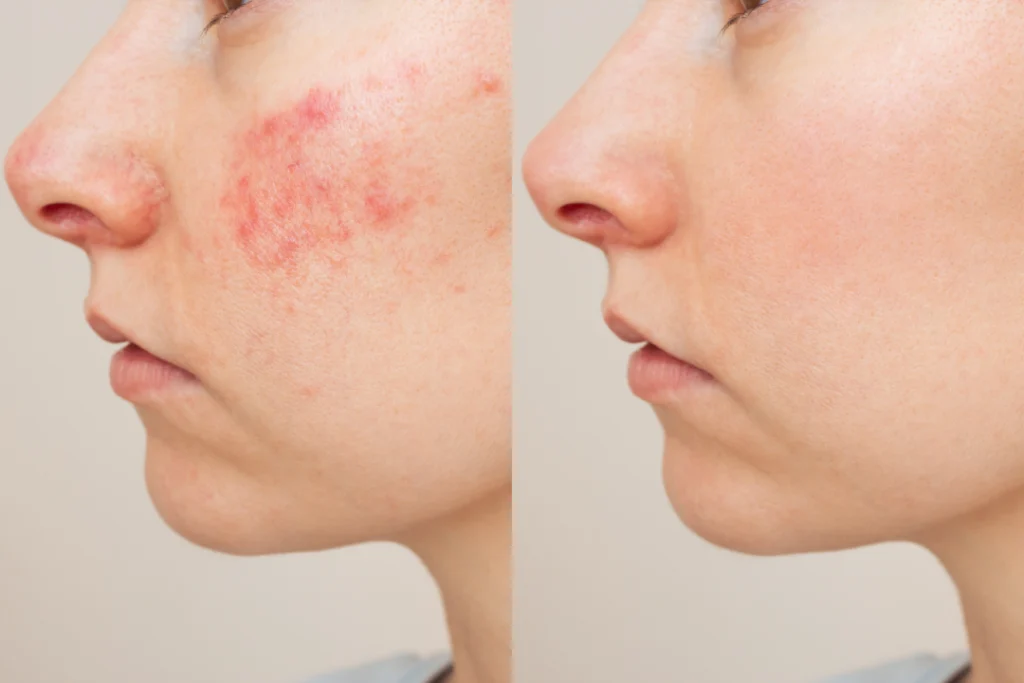 Before and after results of an acne facial treatment showing reduced redness and clearer skin.