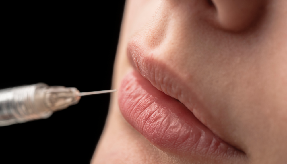 Lip fillers injection session in progress.