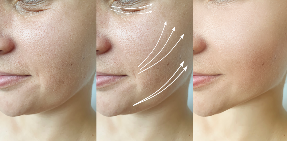 Before and after skin tightening results from PDO threads.