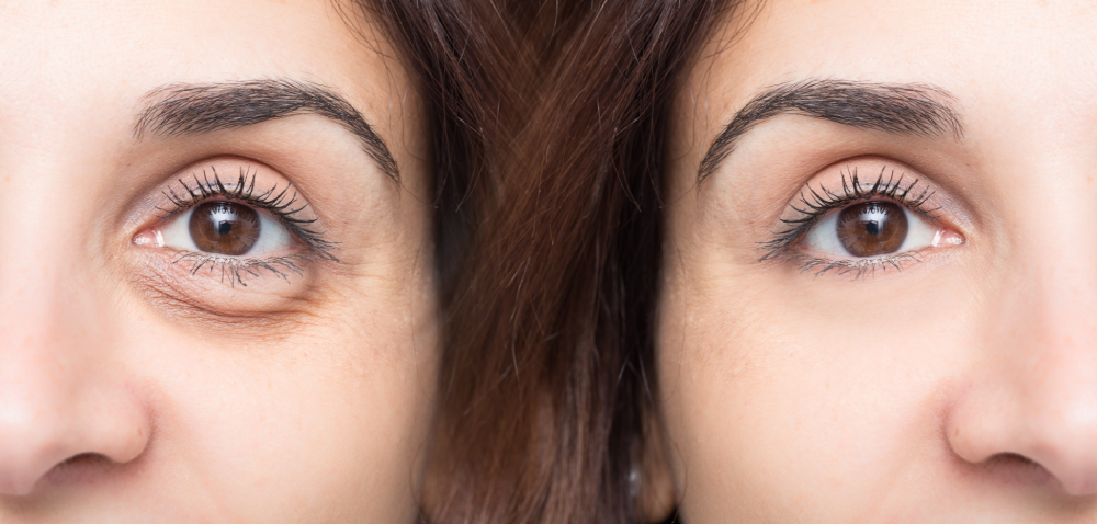 Under eye dermal fillers before and after results.